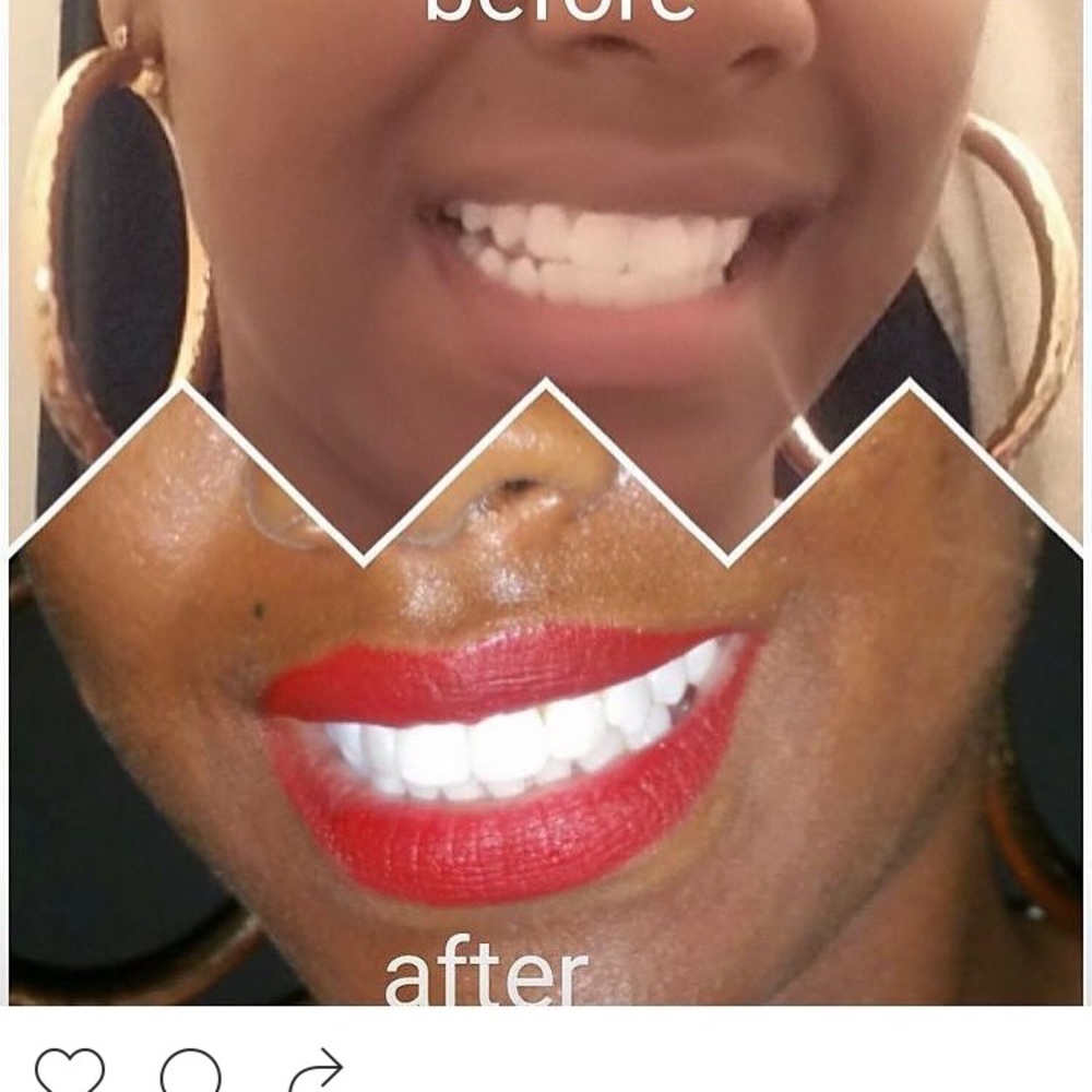 Teeth whitening kits - Picture 3 of 5